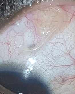 NEOflorax hat geholfen, einen Wurm im Auge loszuwerden